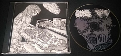 Extrahepatic Bile Duct / Ingrown split CD $6